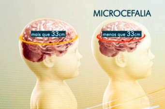 Microcefalia