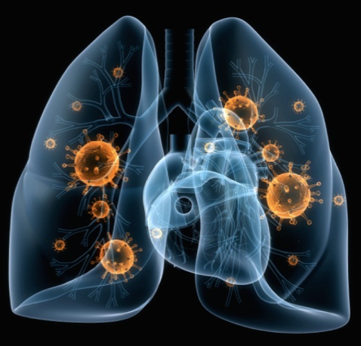 Pneumonia